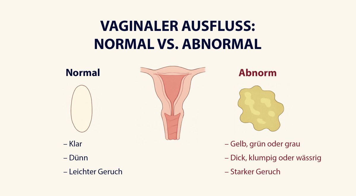 Abbildung mit normalem und unnormalem vaginalen Ausfluss
