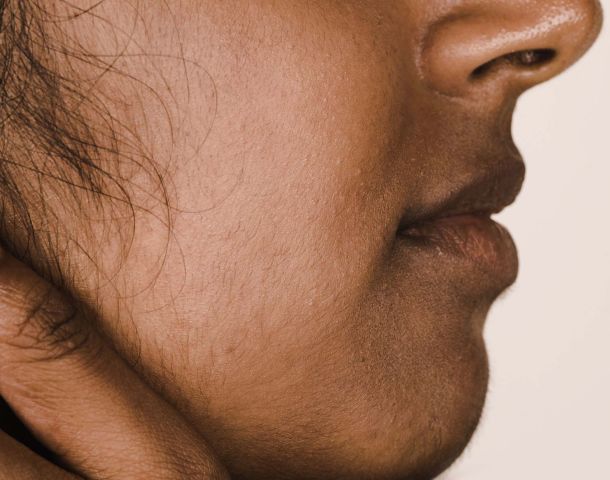What is Hirsutism and What Causes It