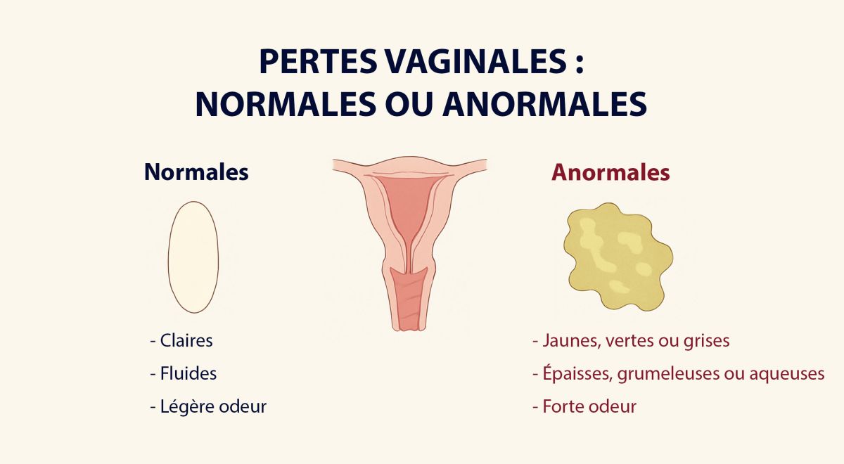 Illustration médicale des pertes vaginales normales et anormales