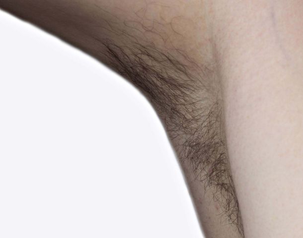 Women's Concerns Over Body Hair